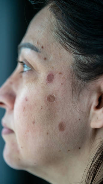 hautproblem ist auf frauen gesicht vertikal noch - toxicodermatitis stock-fotos und bilder