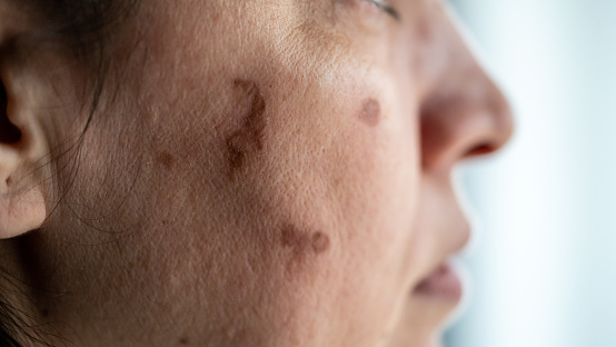women has skin problem horizontal close up still