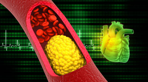 istock Cholesterol blocked arteries with human heart 1471589480