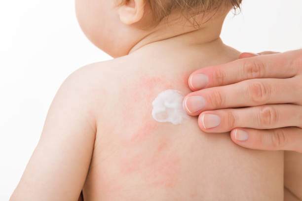 Mother fingers applying white medical ointment on infant bare back isolated on light gray background. Red rash on skin. Allergy from food, milk formula or mother milk. Care about baby body. Closeup. dedos maternos aplicando ungüento médico blanco sobre la espalda desnuda del bebé aislados sobre fondo gris claro. erupción roja en la piel. alergia a los alimentos, fórmula láctea o leche materna. cuidado con el cuerpo del bebé. closeup.