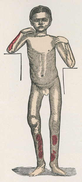 Medical illustration of an adolescent child with congenital syphilis, exhibiting ulcers on the legs. Vintage etching circa 19th century.