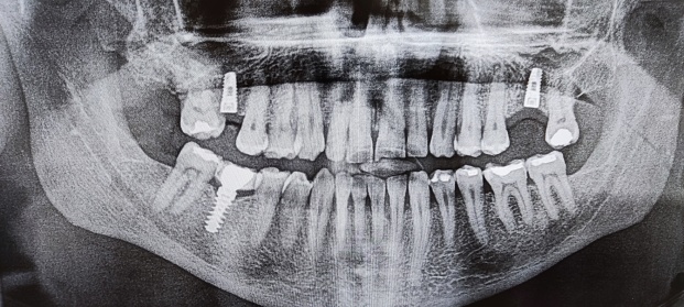 dental radiology, orthopantomography.  doctor observing dental CT.  rx