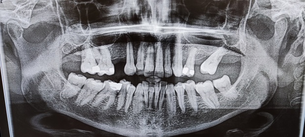 dental radiology, orthopantomography.  doctor observing dental CT.  rx