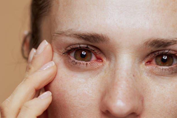 Closeup on young woman with inflamed eyes stock photo