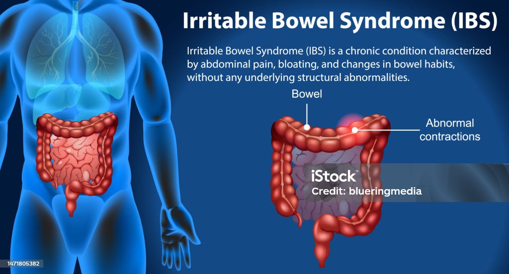 Ibs Graph Irritable Bowel Syndrome Infographic Stock Illustration - Download ...