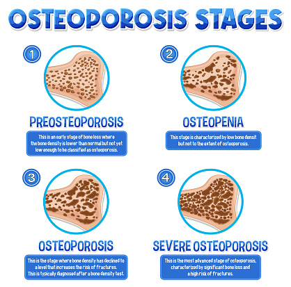 Poster Informatif Osteoporosis Tulang Manusia Ilustrasi Stok Biology Diagrams