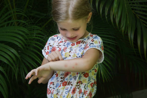 Little girl has skin rash from allergy or mosquito bites stock photo