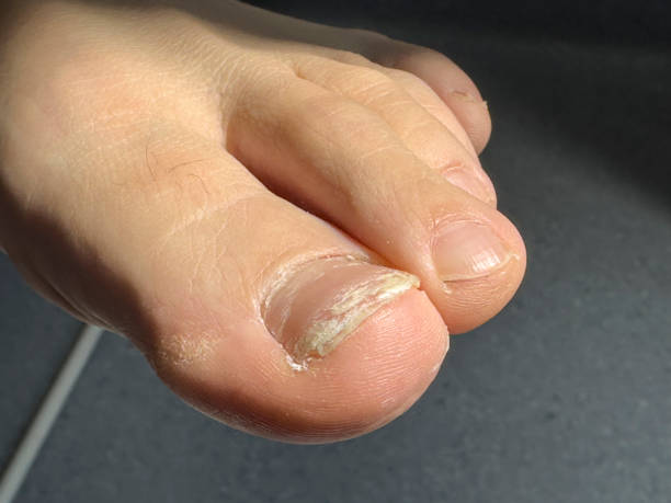 onicomicose - fungus toenail human foot onychomycosis - fotografias e filmes do acervo