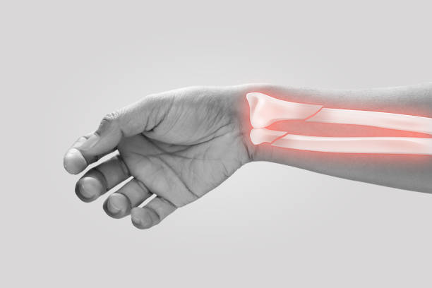 Ulna fracture stock photo