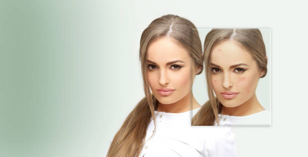 istock Post-Acne Marks .Treating Acne Scars.Acne Scar Removal 1472301288