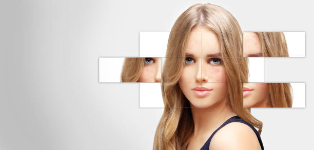 istock Post-Acne Marks Treating Acne Scars.Acne Scar Removal 1472301560