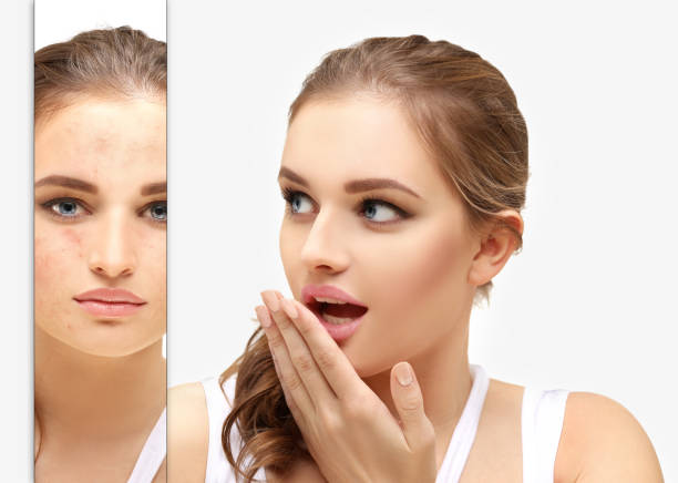 istock Post-Acne Marks .Treating Acne Scars.Acne Scar Removal 1472302495