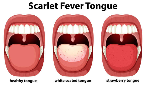 Scarlet fever tongue symptoms vector art illustration