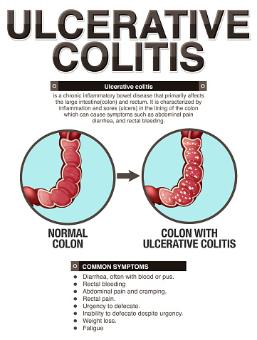Ulcerative Colitis Symptoms Infographic illustration
