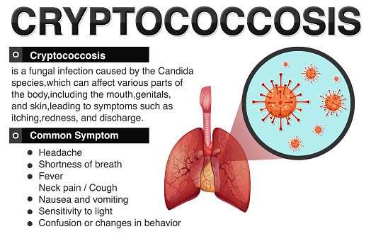 Cryptococcus Infection List Informative Poster Of Cryptococcosis Stock Illustration - Download ...