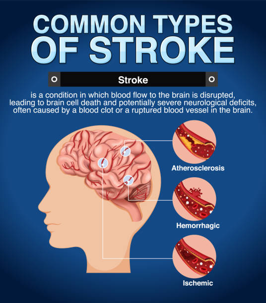 ilustraciones, imágenes clip art, dibujos animados e iconos de stock de póster informativo de los tipos comunes de stoke - anoxia