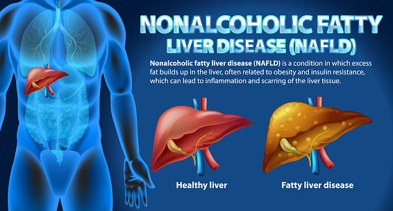 Nonalcoholic Fatty Liver Disease (NAFLD) illustration