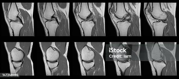 Lacerato Acl Rmi Ginocchio Umano Scansioneadulto Femmina Serie - Fotografie stock e altre immagini di Tomografia computerizzata