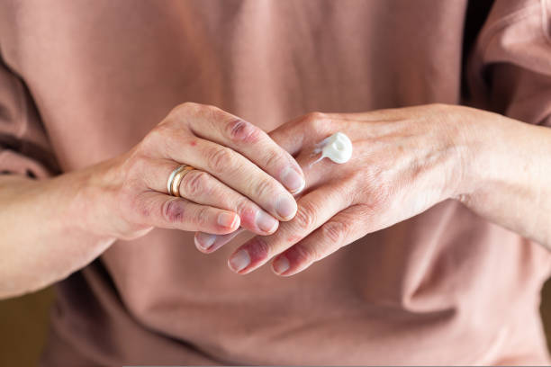 Applying ointment to hands with atopic dermatitis, eczema, allergy Elder woman applying moisturizing cream or ointment to her hands with atopic dermatitis, eczema, allergy reaction on dry skin photo psoriasis stock pictures, royalty-free photos & images
