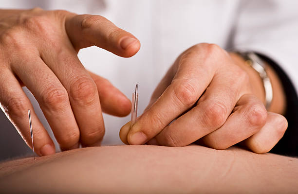 Tapping in acupuncture needle Acupuncturist prepares to tap needle into patients hand chinese herbal medicine stock pictures, royalty-free photos & images