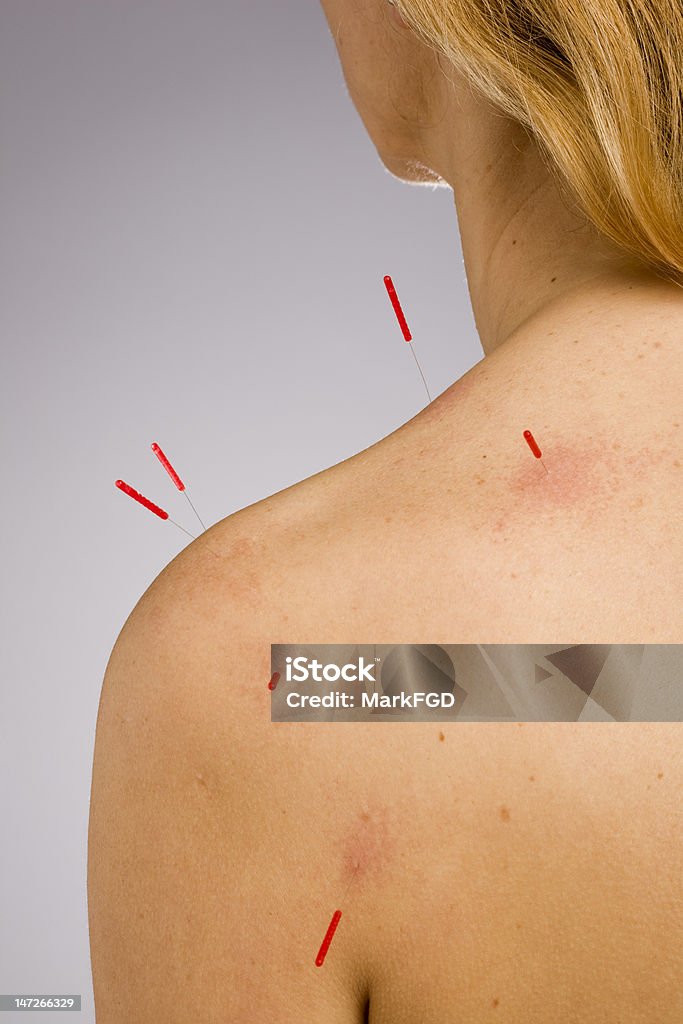 Acupuncture needles in shoulder Woman receiving acupuncture treatment to shoulder Acupuncture Stock Photo