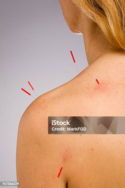 Acupuncture Needles In Shoulder Stock Photo - Download Image Now - Acupuncture, Acupuncture Needle, Adult