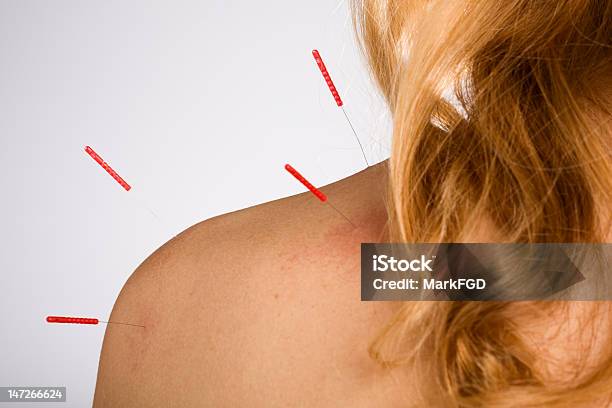 A Closeup Of A Woman Receiving Acupuncture In Her Shoulder Stock Photo - Download Image Now