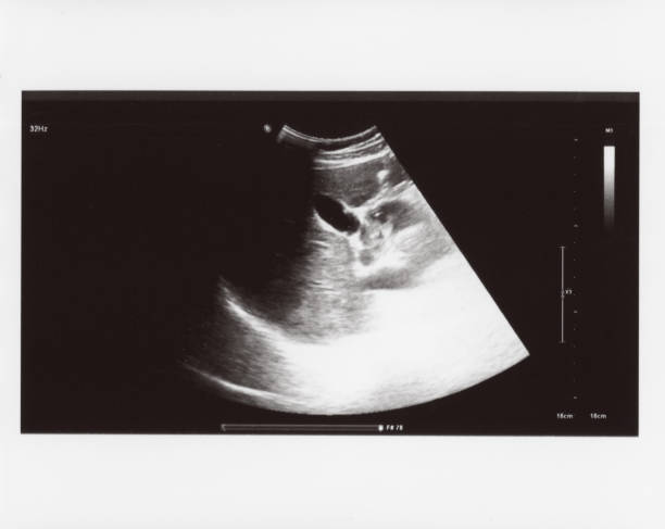 istock full abdomen ultrasound sonogram 1472906670