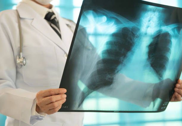 medico radiologia radiografia - human lung asthmatic x ray human internal organ foto e immagini stock