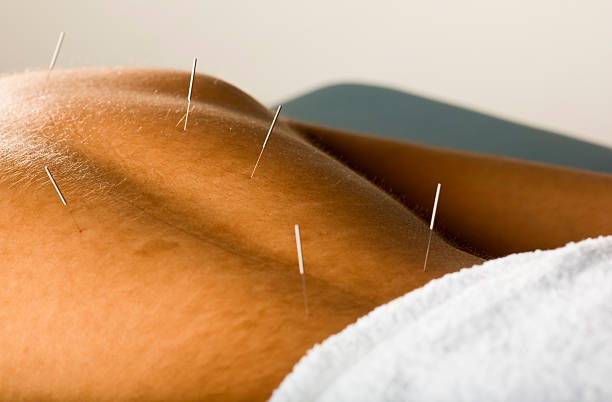 istock Male acupuncture patient 147291902