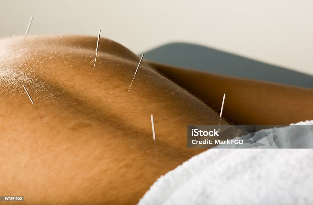 Acupunctura doente do sexo masculino - Royalty-free Acupuntura Foto de stock