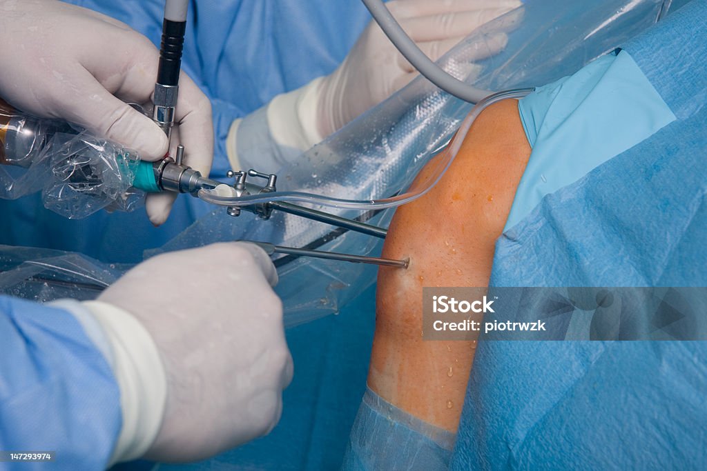 フルニー artroscopy 手術 - 手術のロイヤリティフリーストックフォト