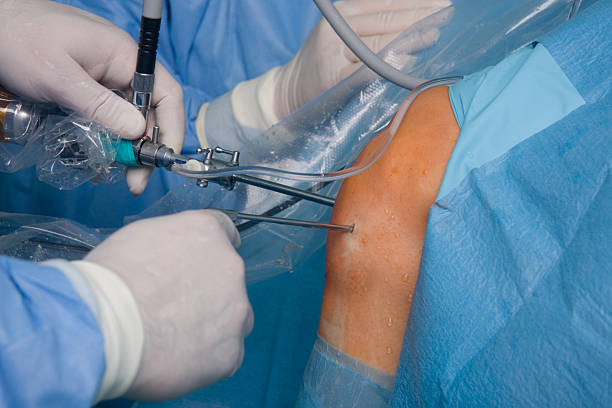 Knee artroscopy  surgery stock photo