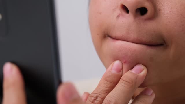 Close up of young woman squeezing pimples on her face. Problematic skin in dark-haired asian woman. Concept of skin problems and skin care.