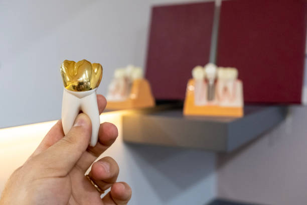 金メッキ臼歯 - gold plated ストックフォトと画像