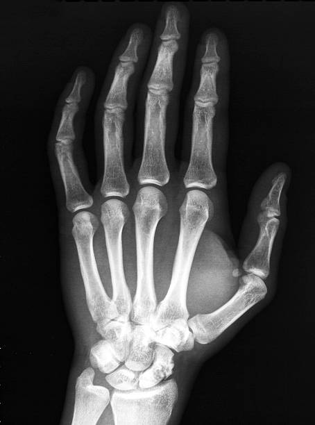 rayos x óseos mano navicular pseudoarthrosis. - hueso de la muñeca fotografías e imágenes de stock