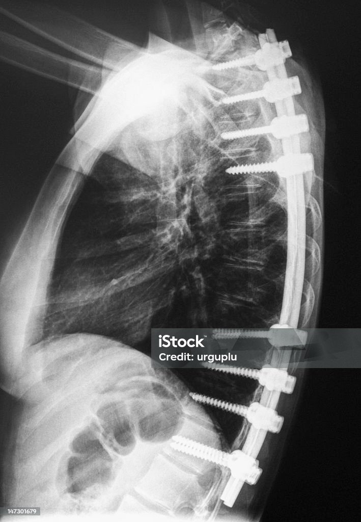 Scoliosis - Lizenzfrei Implantat Stock-Foto