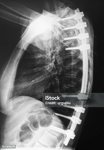 Scoliosis Stockfoto und mehr Bilder von Implantat - Implantat, Wirbelsäule - Mensch, Brustbereich