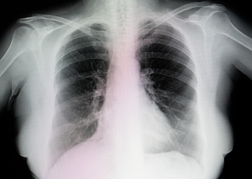 CT Chest 3d rendering showing lung infection from covid-19.