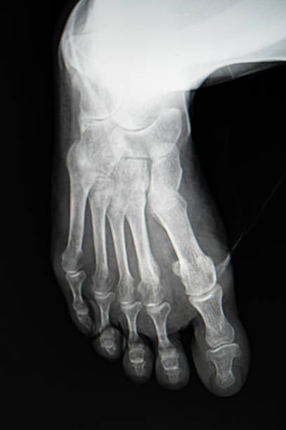 imagem de raios-x do pé. - bending human foot ankle x ray image - fotografias e filmes do acervo