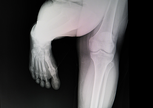 Foot x-ray image.