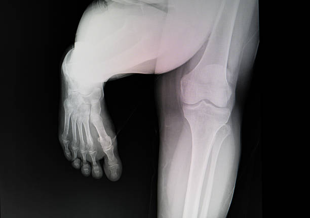 imagem de raios-x do pé. - bending human foot ankle x ray image - fotografias e filmes do acervo