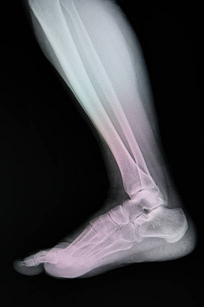 fußröntgenbild. - bending human foot ankle x ray image stock-fotos und bilder