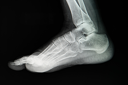 Foot x-ray image.