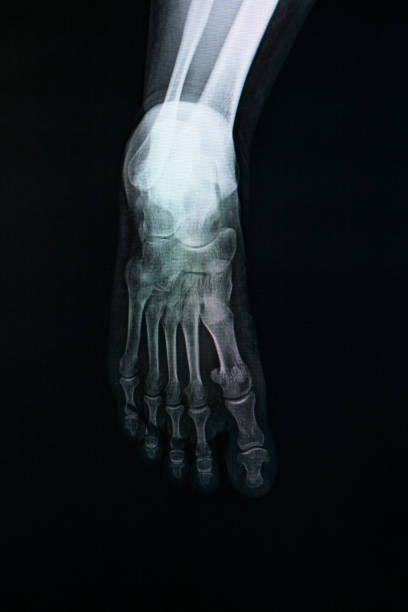 fußröntgenbild. - bending human foot ankle x ray image stock-fotos und bilder