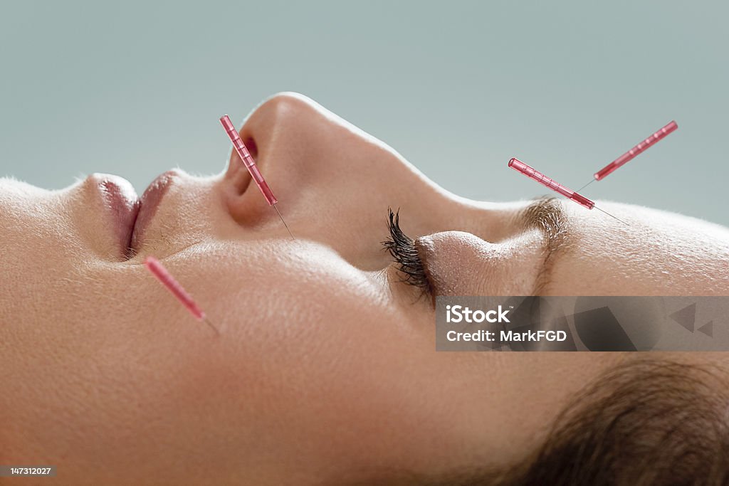 Facial de acupuntura - Foto de stock de Acupuntura royalty-free