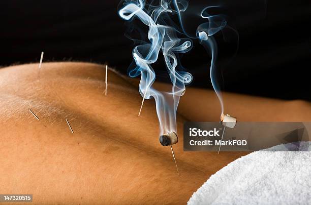 Bruciare Terapia Moxa - Fotografie stock e altre immagini di Terapia moxa - Terapia moxa, Agopuntura, Fitoterapia cinese