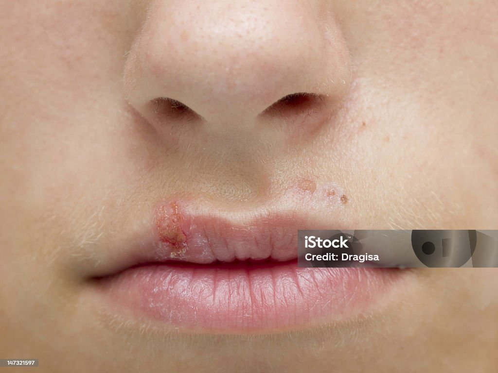 Herpes Closeup of a common cold sore virus herpes simplex. Herpes Stock Photo