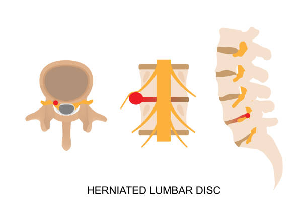 darstellung eines bandscheibenvorfalls in anderer ansicht. - lumbar vertebra stock-grafiken, -clipart, -cartoons und -symbole