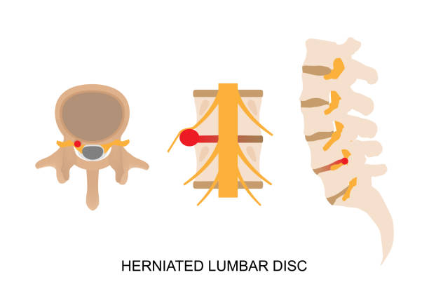 Illustration of herniated lumbar disc in different view. Illustration of herniated lumbar disc in different view. neuralgia stock illustrations